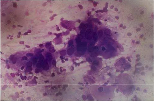 Gambar 4.  Squamous cell carcinoma, inti polimorfis,   khromatin kasar, batas sel jelas, sitoplasma kebiruan (Dikutip dari: Lubis M