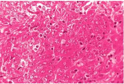 Gambar 9. Undifferentiated  Carcinoma terdiri dari sel-selyang membentuk sarang-sarang padat           ( “Regaud type”)
