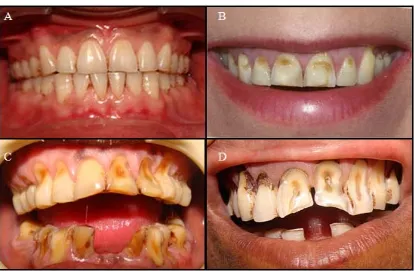 Gambar 9.  A. Abrasi gigi derajat 1; B. Abrasi gigi derajat 2;  C. Abrasi gigi derajat 3;  