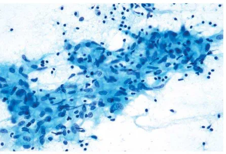 Gambar 3. Limfadenitis granulomatosa. Tampak sel epiteloid pada aspirat penderita limfadenitis tuberkulosis