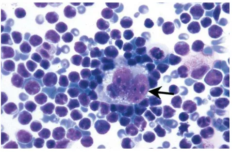 Gambar 4. Limfoma Hodgkin. Tampak sel Reed Sternberg klasik dengan atar belakang limfosit dan eosinofil