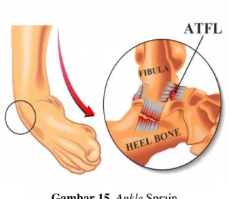 Gambar 15. Ankle Sprain 