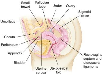 Gambar 3. Lokasi umum endometriosis.1 
