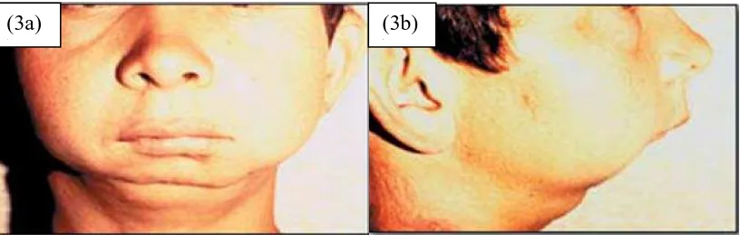 Gambar (3a) Gejala yang diakibatkan ankilosis tampak depan dan (3b) tampak samping. Martins Wd