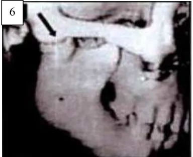 Gambar (5a)  Gambaran CT-scan Oral Cir Bucal 2006:11:68)of temporomandibular joint ankylosis by gap arthroplasty