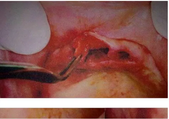 Gambar 2. Pengambilan sisa fraktur prosesus alveolaris pada ekstraksi gigi anterior maksila ( Fragiskos FD