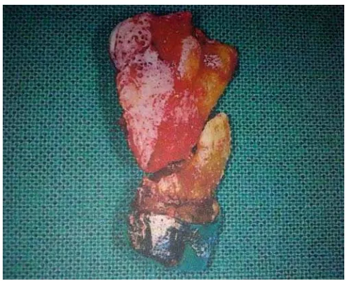Gambar 3. Fraktur tuberositas maksilaris pada ekstraksi molar maksila yang ankilosis ( Fragiskos 