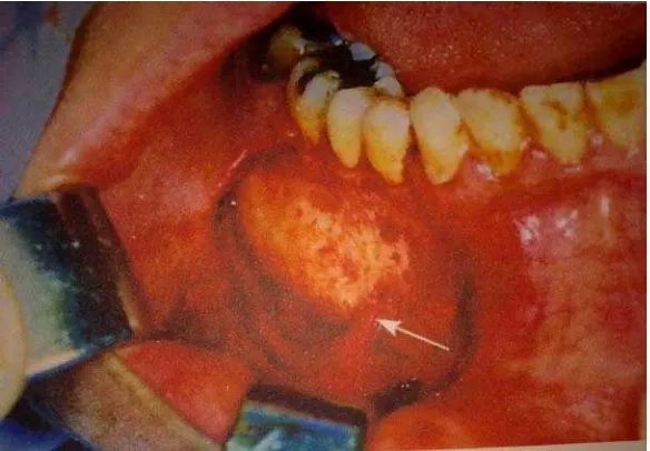 Gambar 4. Trauma yang terjadi pada N. mentalis akibat   retraksi yang berlebihan pada tepi flep ( Fragiskos FD