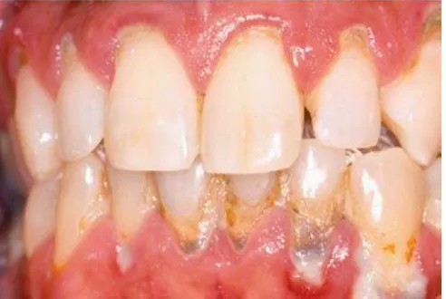 Gambar 5.  Periodontitis disertai dengan mobiliti gigi18 