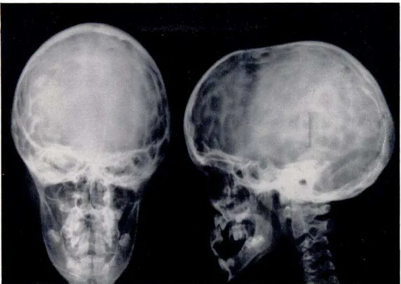 Gambar 3.  Gambaran radiologi kepala dimana terlihat sutura sagitalis                     menutup lebih  awal  dan  tengkorak  kepala  terlihat lebih                    memanjang.1 