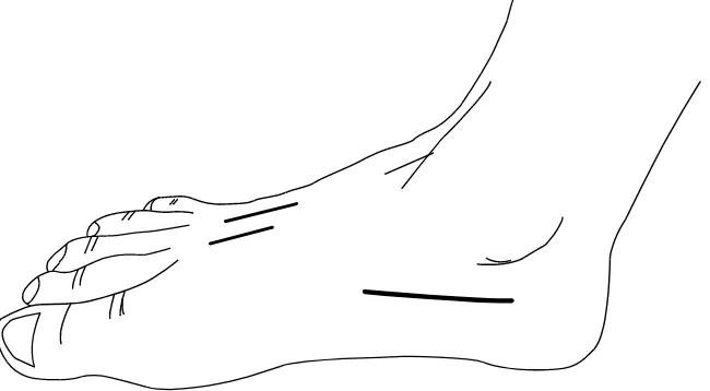 Fig. (8). Incisions for foot fasciotomy. 