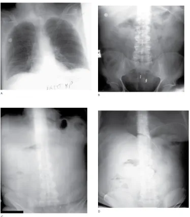 Figure 4. A. Erect AP chest radiograph. B. Supine abdomen. C. Uprightabdomen.D. Upright abdomen repeated after insufflation of 300 mL air viaa nasogastric tube
