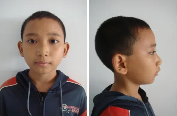 Gambar 1. Foto wajah pasien laki-laki usia 11 tahun sebelum menjalani perawatan ortodontik