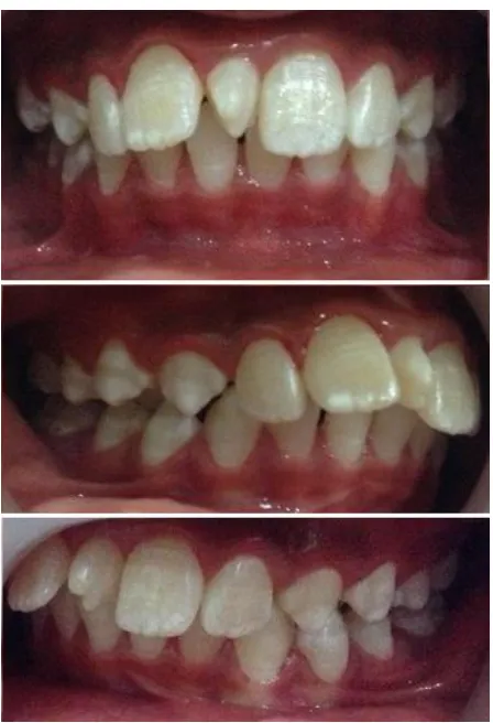 Gambar 2. Foto intraoral keadaan geligi pasien sebelum menjalani perawatan ortodontik
