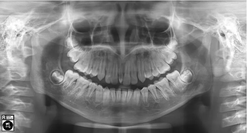 Gambar 3. Model studi pasien sebelum menjalani perawatan ortodontik menunjukkan maloklusi dental kelas I Angle dengan diastema sentral maksila oleh karena mesiodens dan protrusi gigi pada kedua rahang pasien