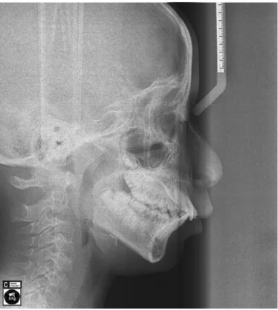 Gambar 5. Foto radiografi sefalometri pasien sebelum menjalani perawatan ortodontik. 