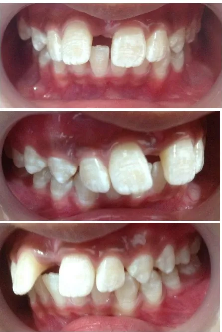 Gambar 6. Foto setelah dilakukan ekstraksi pada gigi mesiodens. 