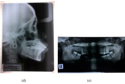 Figure 1. Intra oral photographs (a) right side, (b) front side, (c) left  side, (d)       