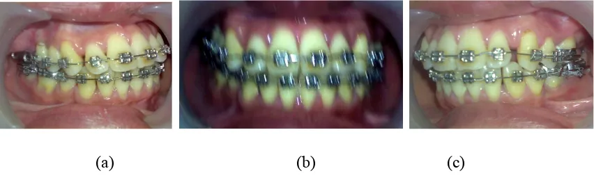 Figure 2.  (a) Miniplates implant placement, (b) miniplates implant, (c) suturing 