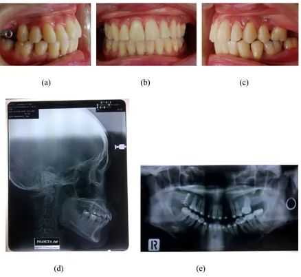 Figure 4. Intra oral photographs (a) right side, (b) front side, (c) left side, (d)     