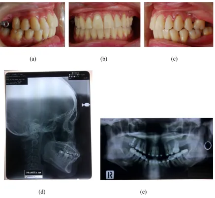 Figure 4. Intra oral photographs (a) right side, (b) front side, (c) left side, (d)     