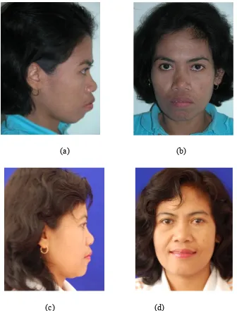 Figure 5. Facial photographs (a) right side, (b) front side before treatment. (c)  