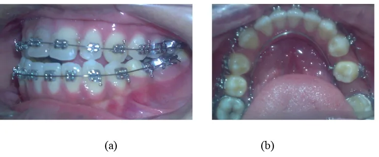Figure 2. Intraoral photographs (a) levelling, (b) lingual arch placement 
