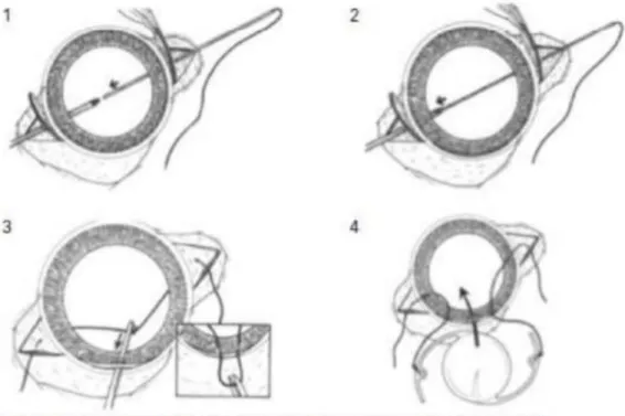 Gambar 3.1 Implantasi lensa intraokular intraskleral dengan teknik ab externo            Dikutip dari :  Jhunjhunwala 2      