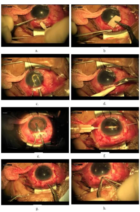Gambar 2.2. ICCE + 5FU + Vitrektomi anterior + Implantasi LIO sekunder fiksasi  sklera dengan teknik ab externo   