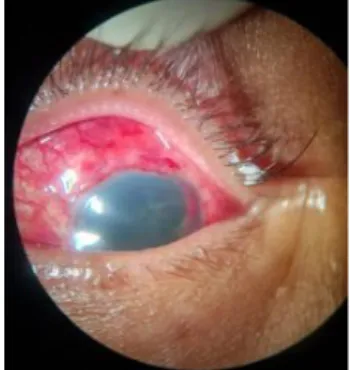 Gambar 2.4. Foto klinis mata kiri hari ke tujuh pasca operasi. 