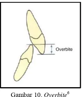 Gambar 10. Overbite6 