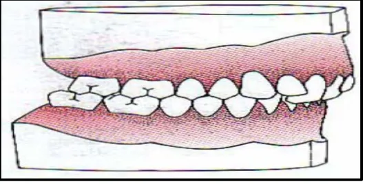 Gambar 5. Klas II Angle Divisi 2. inklinasi insisivus sentralis atas ke lingual dan inklinasi insisivus lateral ke labial6 