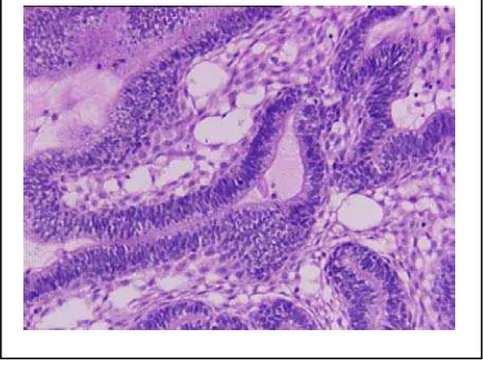 Gambar 4 : Ameloblastoma tipe follikular   (www. pathologyOutlines.com) 