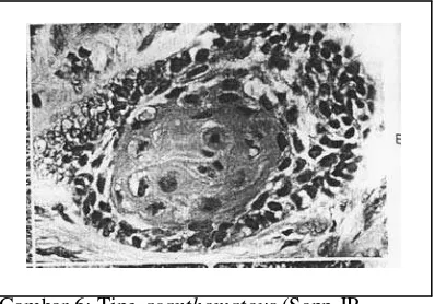 Gambar 5: Ameloblastoma tipe pleksiform (Shklar 