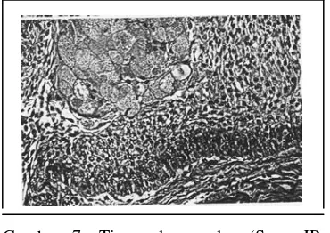 Gambar 7: Tipe sel granular (Sapp JP, Eversole LR, Wysocki GP. Contemporary Oral and Maxillofacial Pathology