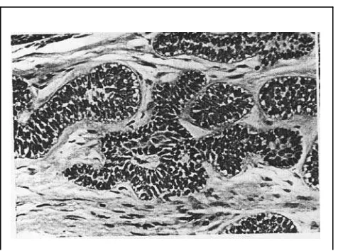 Gambar 8: Tipe sel basal (Sapp JP, Eversole LR, Wysocki GP.  Contemporary Oral and Maxillofacial Pathology