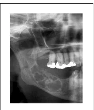 Gambar 9: Multiokular ameloblastoma (http://www.radpod.org/2007/08/01/ ameloblastoma/) 