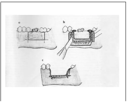 Gambar 11: Eksisi Blok  (Thoma KH, Vanderveen JL. Oral Surgery. 5th Ed.Saint Louis;The C.V
