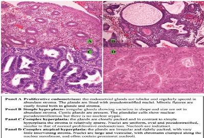 Gambar 2.9. Klasifikasi Histologi Hiperplasia Endometrium 1 
