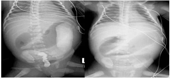 Gambar 2.3. : Radiografi perut menunjukkan loop melebar usus. Kontras enema menunjukkan    