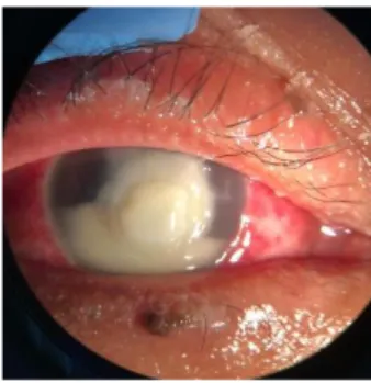Gambar 4.1 Segmen anterior mata kanan Tn. D sebelum operasi  Dikutip dari: PMN RS Mata Cicendo 