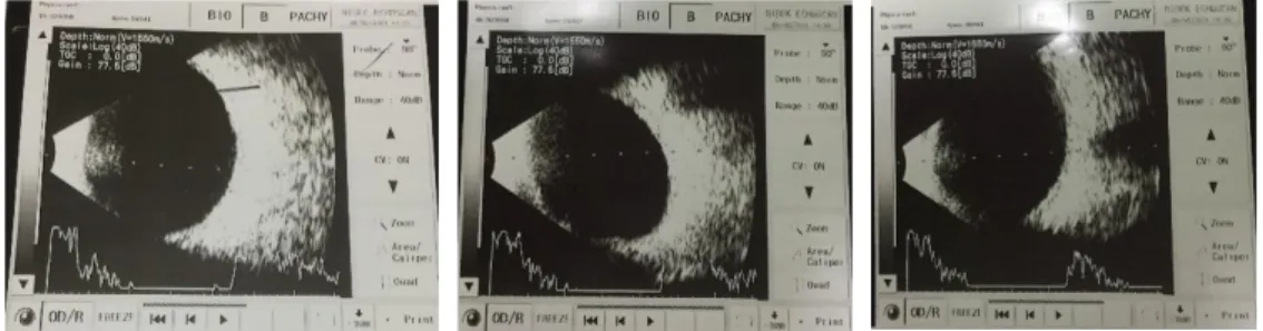 Gambar 4.3 Hasil USG mata kanan Tn. D pasca operasi satu hari    Dikutip dari: PMN RS Mata Cicendo 