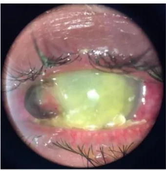 Gambar 2.1 Segmen anterior mata kiri Ny. J sebelum operasi  Dikutip dari: PMN RS Mata Cicendo 