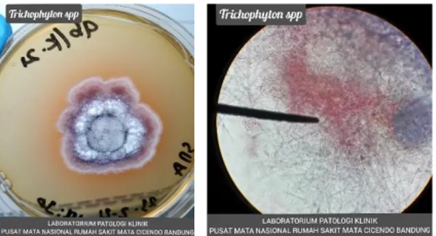 Gambar 2.4 Segmen anterior mata kiri Ny. J setelah satu minggu operasi   Dikutip dari: PMN RS Mata Cicendo 