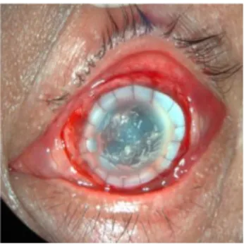 Gambar 3.2 Segmen anterior mata kiri ny. U satu hari setelah operasi   Dikutip dari: PMN RS Mata Cicendo 