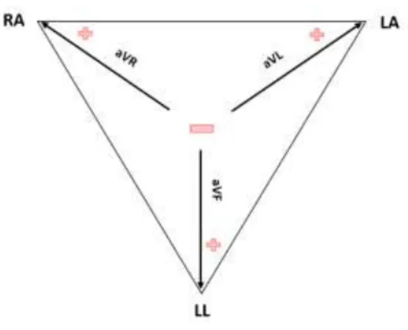 Gambar 2. 5 Einthoven’s Triangle. [15] 
