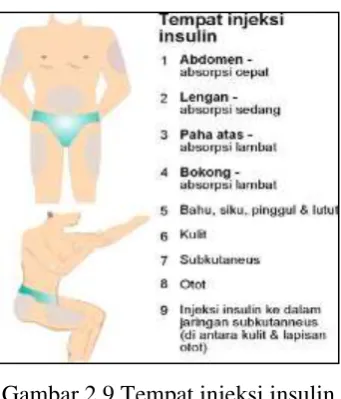 Gambar 2.10 Cara pakai alat insulin 
