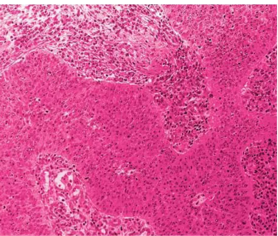 Gambar 2.4 Non Keratinizing Squamous Cell Carcinoma (Dikutip dari: Rosai J. Rosai and Ackermans Surgical Pathology,Volume one, Ninth 