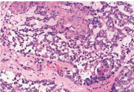 Gambar 2.7 Undifferentiated Carcinoma terdiri sel-sel yang tumbuh membentuk gambaran syncytial yang difus (Schmincke type)