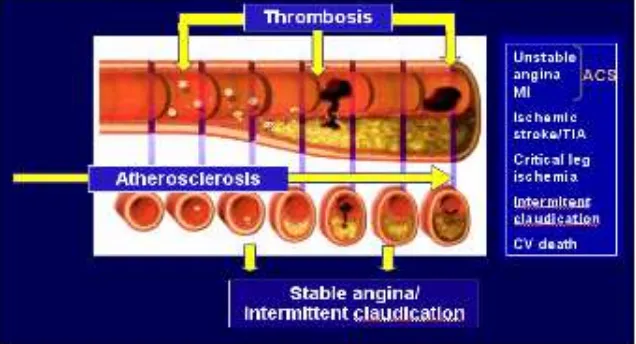 Gambar 2.3. Perjalanan Prosese Aterosklerosis (Initation, Progression, dan Complication) Pada Plak Aterosklerosis  (Departemen Kesehatan, 2006) 